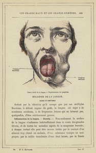 Cancro ulcerato della lingua, degenerazione dei gangli (litografia a colori) da French School