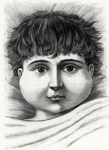 Bambino con parotite (incisione) da French School