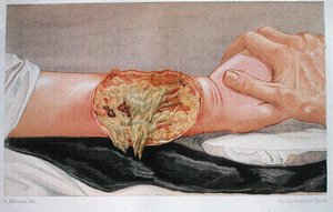 Gangrena ospedaliera, da 