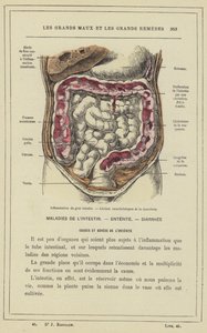 Infiammazione del colon, lesioni caratteristiche della dissenteria (litografia a colori) da French School