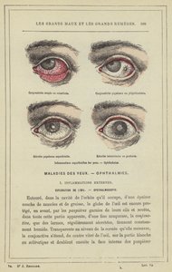 Infiammazioni superficiali degli occhi, oftalmie da French School