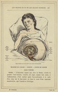 Cisti areolare dell