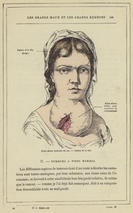 Cisti sierosa compartimentata del collo, lipoma della testa (litografia a colori) da French School
