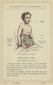 Lesioni caratteristiche della febbre tifoide (litografia a colori) da French School