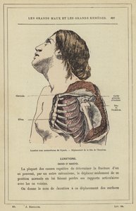 Lussazione sotto coracoidea della spalla, Spostamento della testa dell