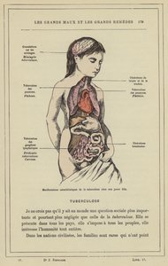 Manifestazioni caratteristiche della tubercolosi in una giovane ragazza da French School