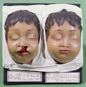 Modello che mostra il viso di un bambino prima e dopo un