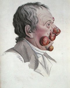 Micosi Fongoide, da un libro di Baron Jean Louis Alibert