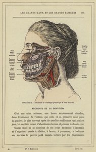 Nervi dentali, meccanismo del mal di denti causato dalla carie (litografia a colori) da French School
