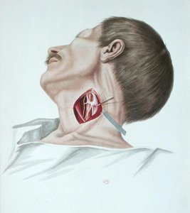 Operazione su un aneurisma, da 