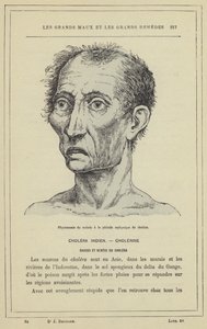 Fisionomia del malato nel periodo asfittico del colera da French School