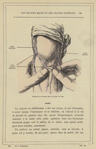 Posizione della lancetta nella salasso del braccio (litografia a colori) da French School