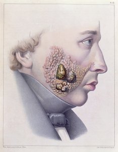 I sintomi facciali della malattia venerea, da Traite Complet des Maladies Veneriennes di Philippe Ricord (1800-89) 1851