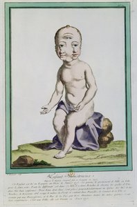 Bambino con testa deformata, da 
