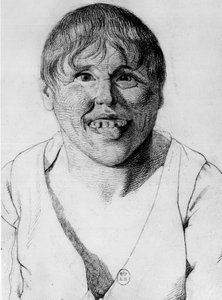 Cretino - in “Etude de la physionomie des aliénés”, disegno di Gabriel da Georges Francois Gabriel