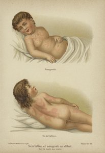 Primi sintomi di morbillo e scarlattina