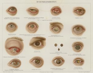 Disturbi oculari da German School