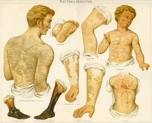 Disturbi della pelle, c.1890