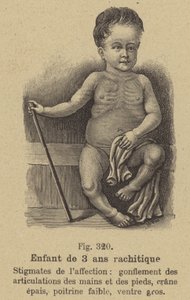 Bambino di tre anni affetto da rachitismo