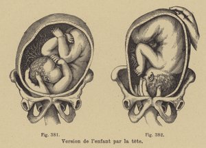 Girare un bambino nel grembo materno in modo che la testa sia rivolta verso il basso prima della nascita da German School