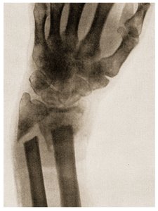 Radiografia di un polso fratturato c.1890 da German School