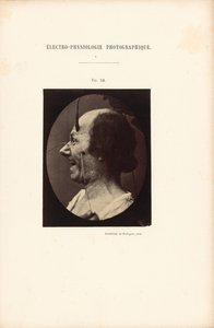 Elettrofisiologia fotografica, Figura 39 da Guillaume Benjamin Duchenne