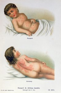 Morbillo e scarlattina, da un libro medico di famiglia, c.1900
