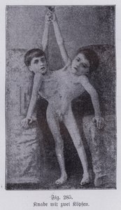 Giacomo e Giovanni Battista Tocci, gemelli siamesi italiani