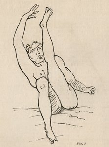 Epilepsia isterica, attacco, contorsioni, fig. 2 da 