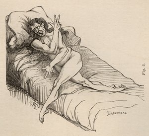 Epilepsia isterica, attacco, contorsioni, fig. 3 da 