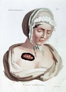 Cancro antracico - Alibert, B.N.