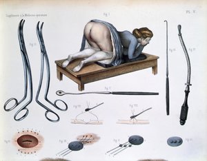 Operazione su una fistola vescico-vaginale, da 