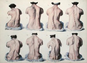 Deformità spinali, tavola da 