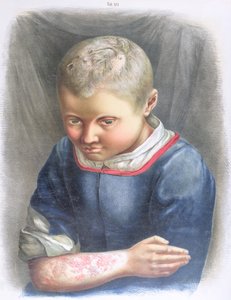 Favus, da un libro di Daniel Cornelius Danielssen (1815-94) 1892