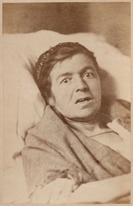 Epilepsia isterica, contrazione del viso, tavola VIII da 