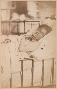 Epilepsia isterica, contrazione permanente, tavola XXVIII da 