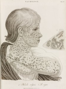 Malattie, Morbillo Due tipi di morbillo