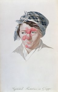 Pustole sifilitiche a grappolo, da un libro di Baron Jean Louis Alibert (1768-1837) 1838