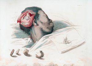 Vista della ferita nel cranio dopo trapanazione e rimozione del pezzo di osso frantumato in basso a sinistra, 1821 da Thomas Landseer