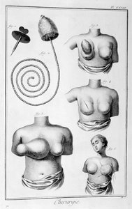 Chirurgia del seno, 1751-1777 da Unbekannt