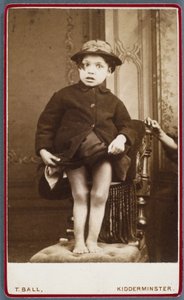 Malattie, Rachitismo Bambino con rachitismo
