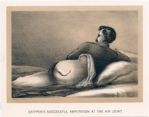 Amputazione riuscita di Shippen all