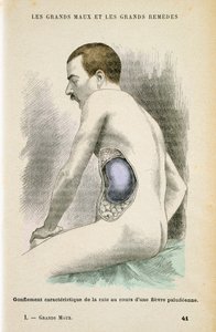 Milza ingrandita tipica di un paziente con malaria, c1890 da Unbekannt