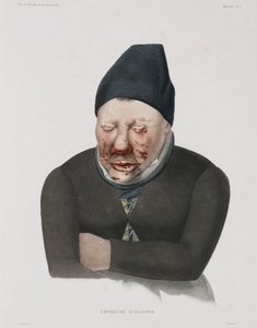 Malattie, lebbra