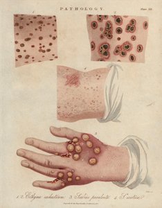 Ulcera cutanea, scabbia purulenta e scabbia causata da un acaro sarcoptico della scabbia - Litografia di John Pass, pubblicata in 