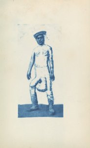 Elefantiasi da Unknown 19th Century