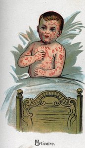 Malattie infantili: Orticaria. In “La nuova medicina naturale” di F.E. Bilz
