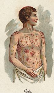 Malattie infantili: La scabbia. In "La nuova medicina naturale" di F.E. Bilz