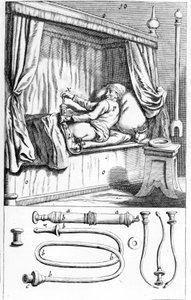 Clystère (per clisteri) di Johannes Sculptetus “Armamentarium Surgical”. Venezia 1665 da Unknown artist