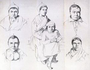 Considerazioni sulle cause del cretinismo endemico di Morel